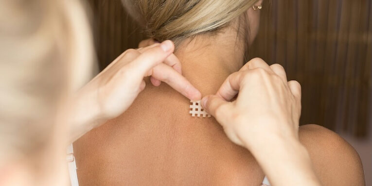 caucasian woman gets a cross kinesio tape in her neck for pain relief in cervical syndrome FEATURE IMAGE
